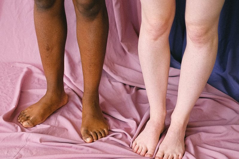 What are bunions?